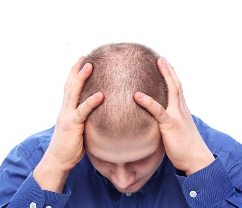 The Cure For Baldness Might Be Plucking Your Hair Out The Washington Post