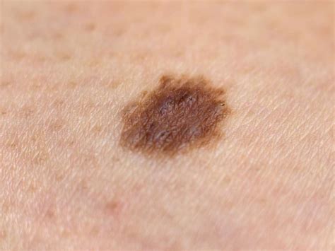 New Moles And What To Look Out For Medical News Corner