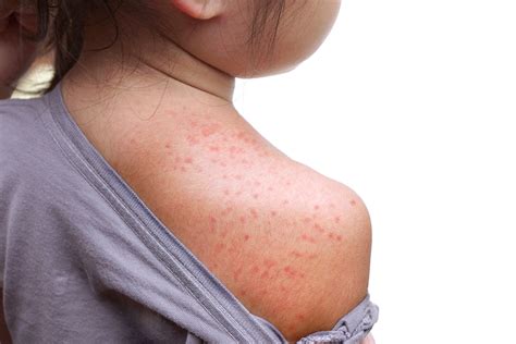 Red Rash On Baby Skin At The Back Roseola Infantum Exanthema