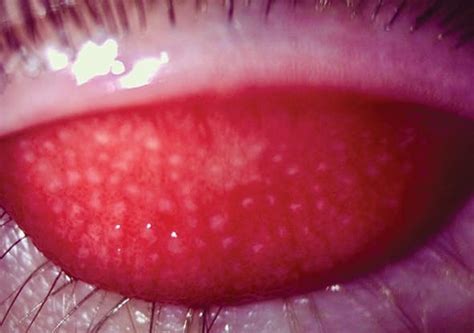 Giant Papillary Conjunctivitis Diagnostic Pearls Modern Optometry