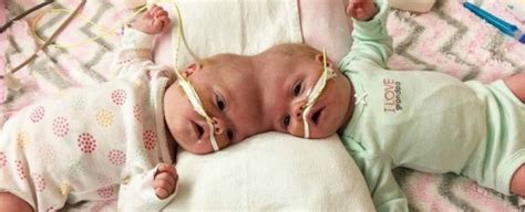 conjoined twins have survived one of the world s rarest surgeries sciencealert