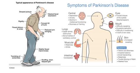 Parkinsons Disease Affects Over 10m Globally Foundation