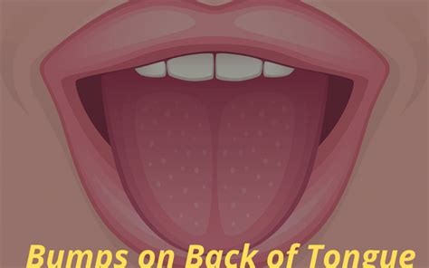 Bumps On Back Of Tongue Diagnosis Causes And Treatment And Prevention Healthyell