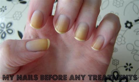 How To Whiten Yellow Nails Simple Home Remedies That Work Yellow Nails Trendy Nails Nails