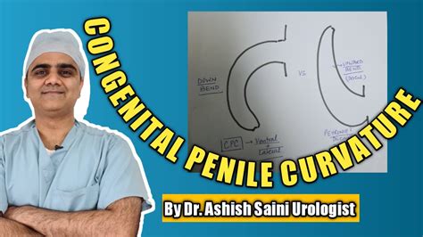 Bend Penis In Young Age Congenital Penile Curvature Or Peyronie Youtube