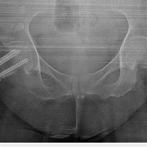 Anteroposterior Both Hips Radiograph With Right Femoral Neck Fracture
