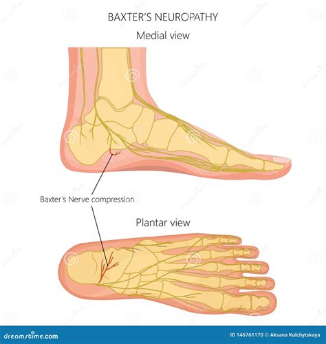 Nerves Of The Foot 02 Stock Vector Illustration Of Mortons 146761170