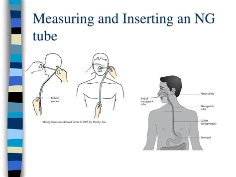 What Is Nasogastric Tube Insertion