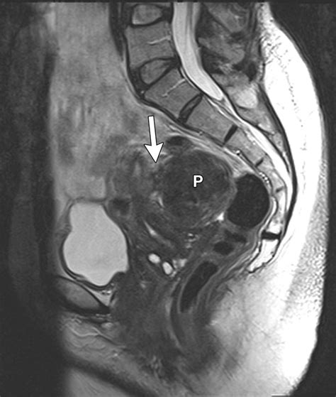 role of mr imaging of uterine leiomyomas before and after embolization radiographics