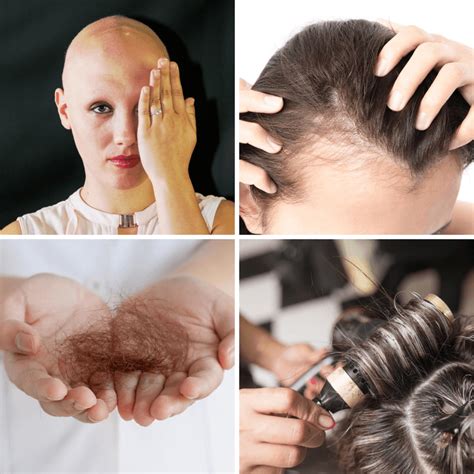 Female Pattern Hair Loss Facts Three Treatments To Combat Balding