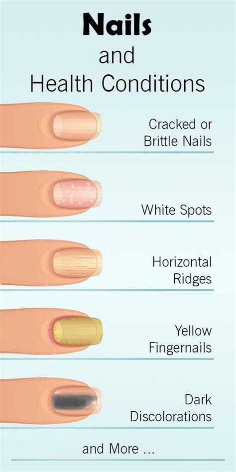 What Do Your Nails Say About Your Health