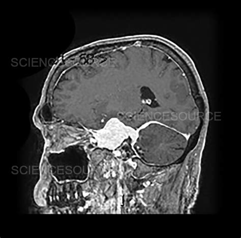 Skull Base Meningioma 8 Stock Image Science Source Images