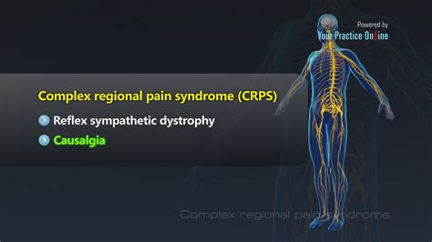 Complex Regional Pain Syndrome Video Causes And Symptoms