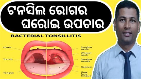 Tonsils Treatment Tonsillitis Natural Home Remedies How To Care