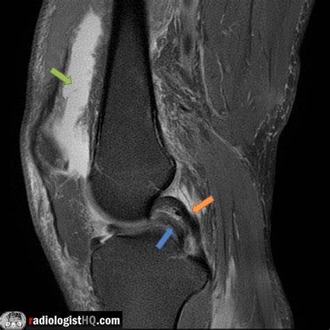 Double Posterior Cruciate Ligament Sign On Mri Rradiology
