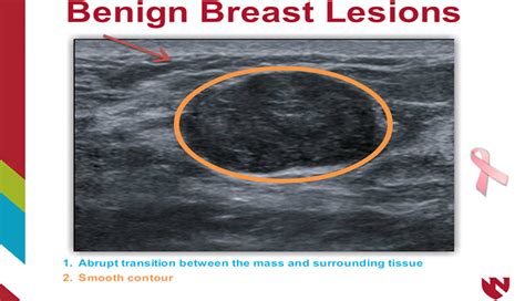 Benign Breast Lesions Breast Pathology Case Studies E Gallery