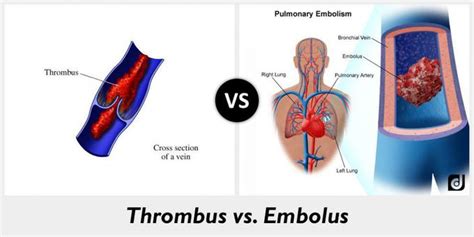 Thrombosis Vs Embolism MEDizzy