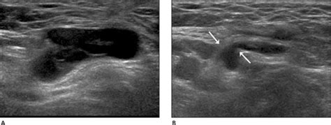 Sonography Of Various Cystic Masses Of The Female Groin Oh 2007