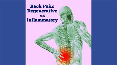 Back Pain Inflammatory Versus Degenerative Chicago Arthritis And