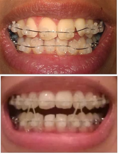 My Damon Clear Braces Week 23 Before And After Pictures