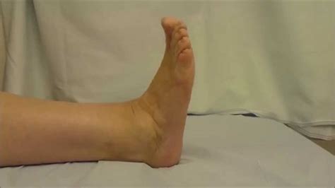 Movement After Ankle Fusion Youtube