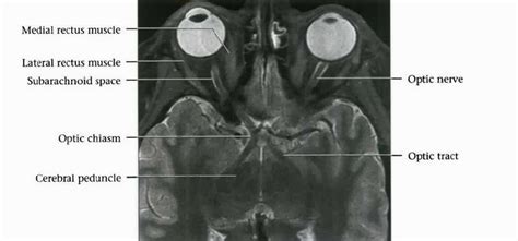 Radiology Anatomy Images Optic Chiasm MRI Anatomy