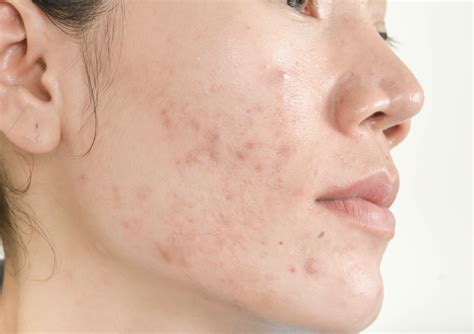 When Should You Seek The Help Of A Professional For Your Acne