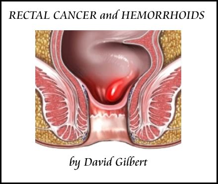 Rectal cancer is only one of the possible causes of this symptom, however, so unexplained weight loss always deserves a visit to your doctor. Hemorrhoids — Page 5
