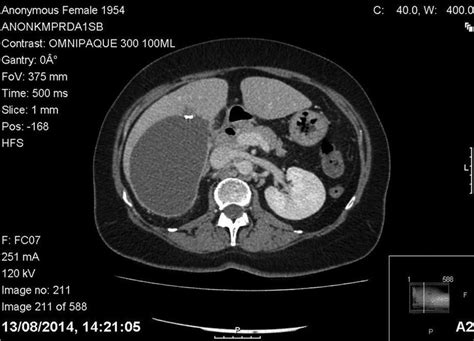 A Rare Case Of Subcapsular Liver Haematoma Following Laparoscopic
