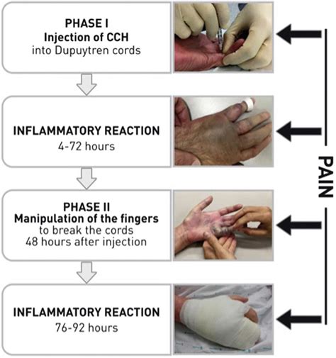 Phases Of Treatment In Dupuytren Contracture Release With Cch
