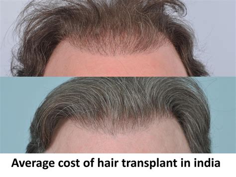 Best Hair Transplant Clinic In Delhi By Dmctrichology Issuu