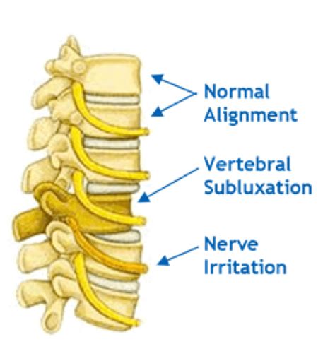 The Anatomy Of A Subluxation Healthful Chiropractic Upper Cervical Care