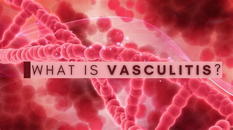 What Is Vasculitis Know About The Causes Types Symptoms And
