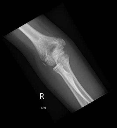 Elbow Series Summary Radiology Reference Article Radiopaedia Org