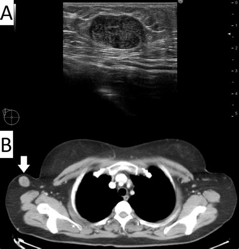 Phyllodes Tumour Arising In The Ectopic Axillary Breast Tissue