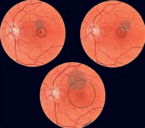 Clinically Significant Macular Edema