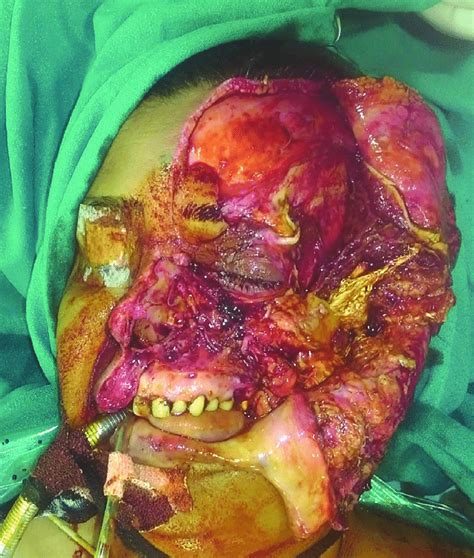Preoperative picture showing complete hemifacial and zygomatic ...