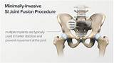 Photos of Si Joint Fusion Surgery Recovery