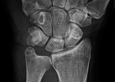 Pisiform Fracture Hand Orthobullets