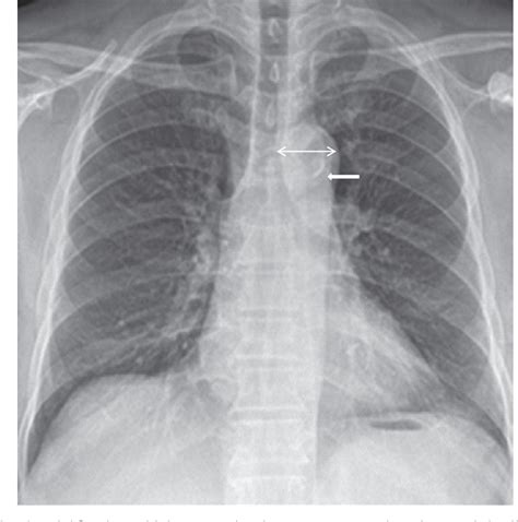 Figure 2 From The Clinical Significance Of Aortic Calcification In