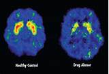 How Does Marijuana Affect Your Brain Cells Photos