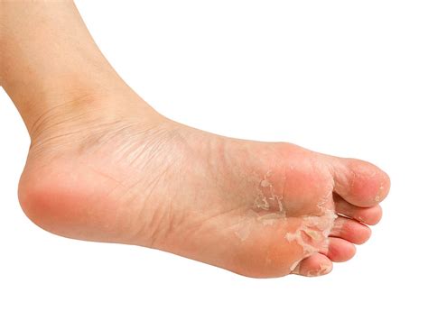 How To Get Rid Of Athletes Feet Expert Advice On Cures And Tips