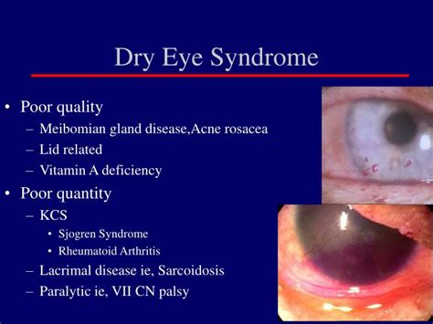 Ppt The Red Eye Differential Diagnosis Powerpoint Presentation Id