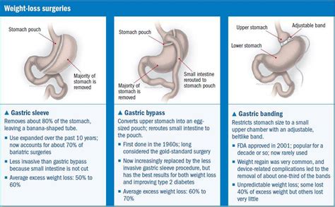 Check spelling or type a new query. What is Bariatric Surgery? Becoming a Gastric Sleever