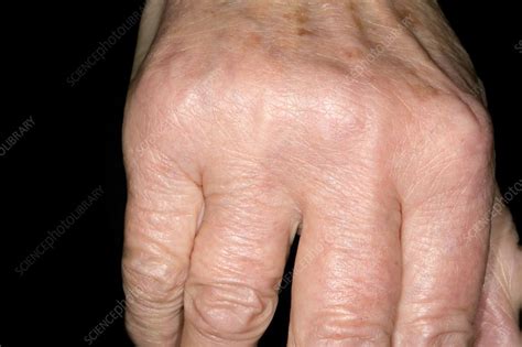 Osteoarthritis Of The Hand Stock Image C0194171 Science Photo