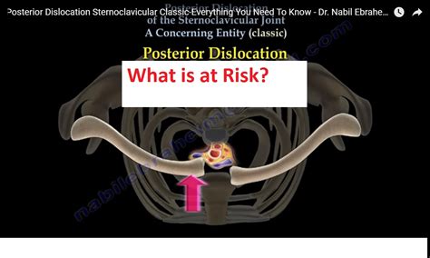 Posterior Sternoclavicular Dislocation —