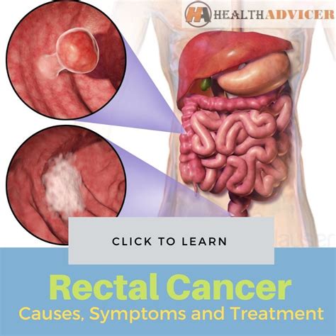 Rectal Cancer Causes Picture Symptoms And Treatment