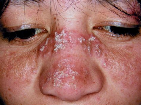 Discoid Lupus Erythematosus Primarily Affects Your Skin