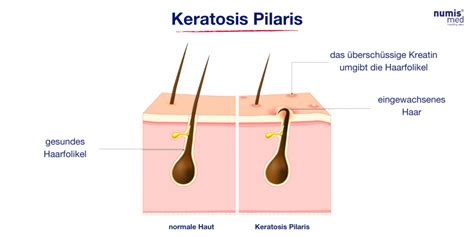 Reibeisenhaut Ursachen Und Behandlung Numis® Med