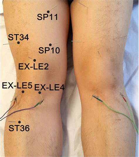 Influence Of Acupuncture In Treatment Of Knee Osteoarthritis And